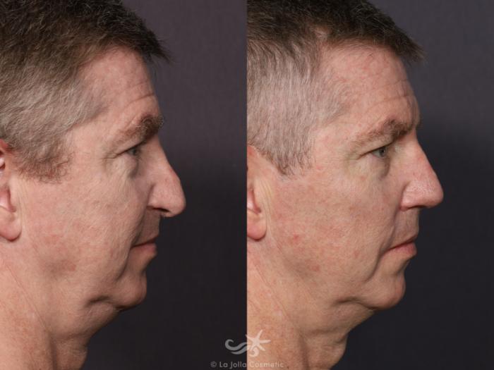 Before & After Revision Rhinoplasty Result 711 Right Side View in San Diego, Carlsbad, CA