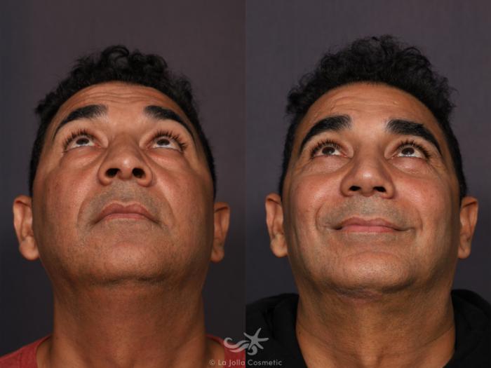 Before & After Revision Rhinoplasty Result 773 Base View in San Diego, Carlsbad, CA