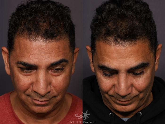 Before & After Revision Rhinoplasty Result 773 Cephalic View in San Diego, Carlsbad, CA