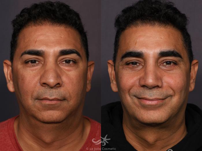 Before & After Revision Rhinoplasty Result 773 Front View in San Diego, Carlsbad, CA