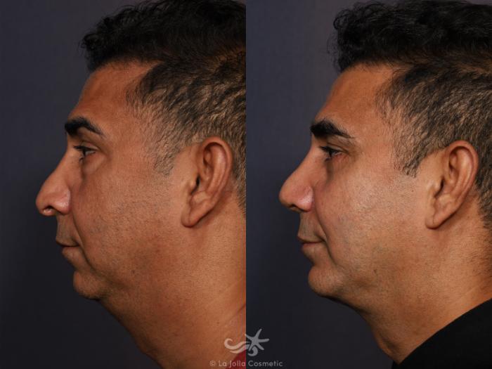 Before & After Revision Rhinoplasty Result 773 Left Side View in San Diego, Carlsbad, CA