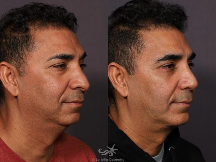 Before & After Revision Rhinoplasty Result 773 Right Oblique View in San Diego, Carlsbad, CA