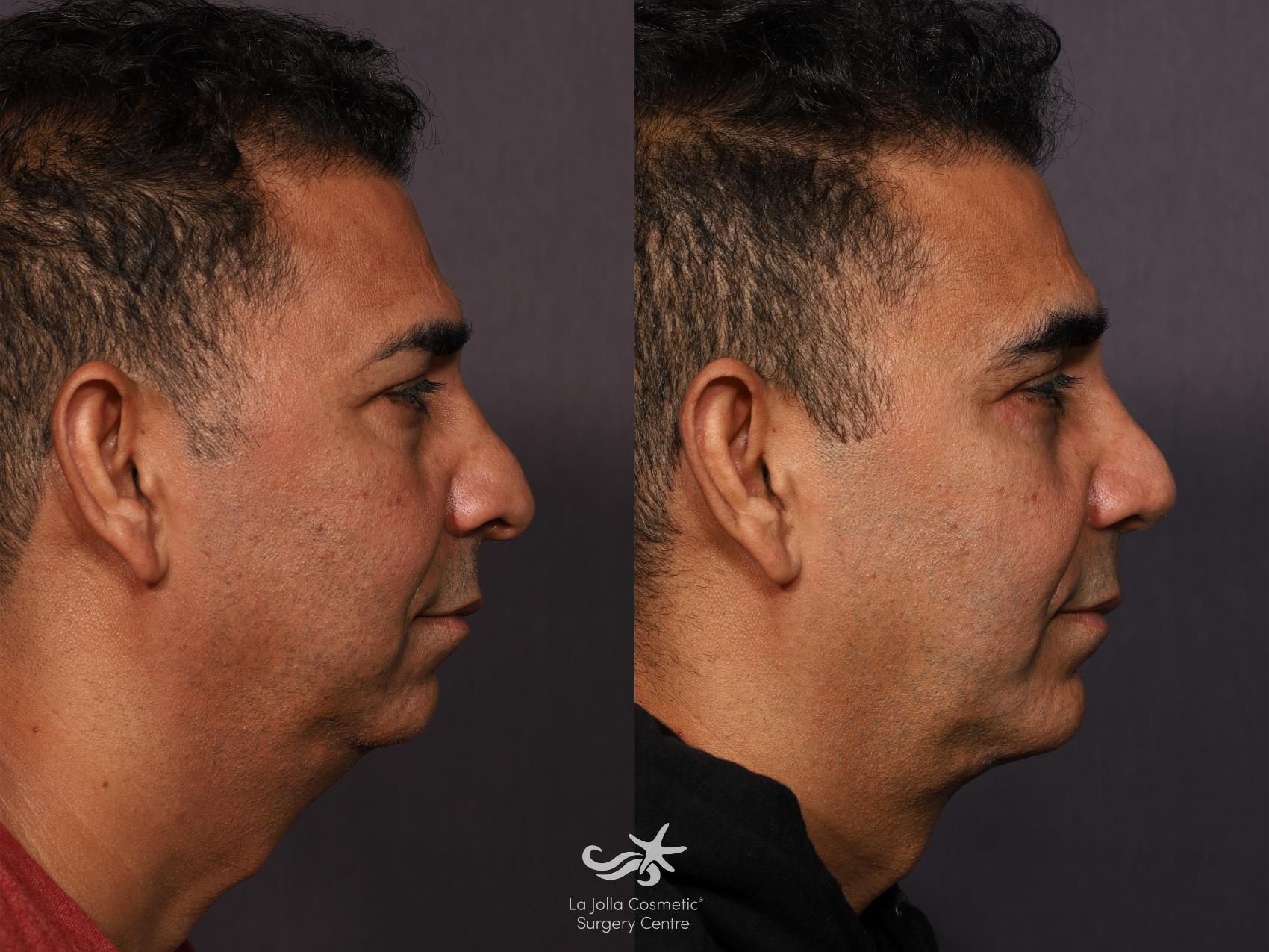 Before & After Revision Rhinoplasty Result 773 Right Side View in San Diego, CA