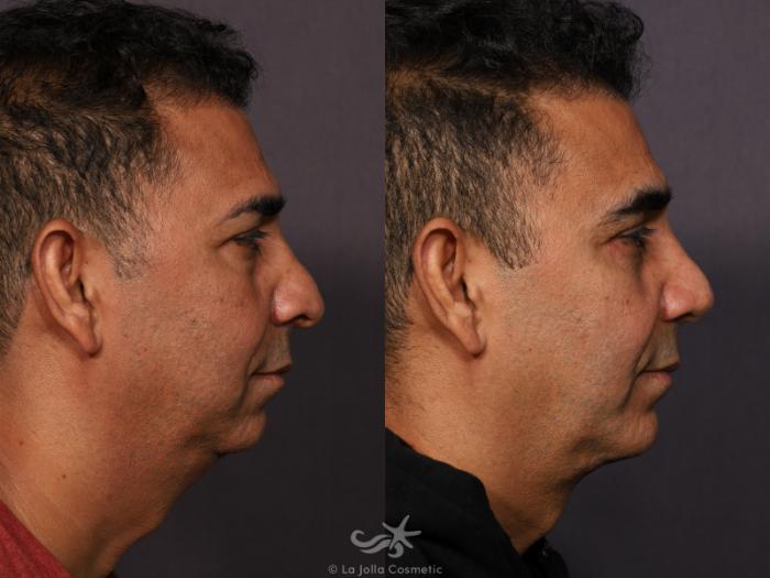 Before & After Revision Rhinoplasty Result 773 Right Side View in San Diego, Carlsbad, CA