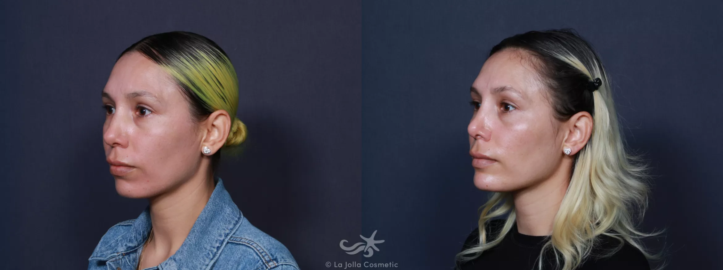 Before & After Rhinoplasty Result 109 Left Oblique View in San Diego, CA