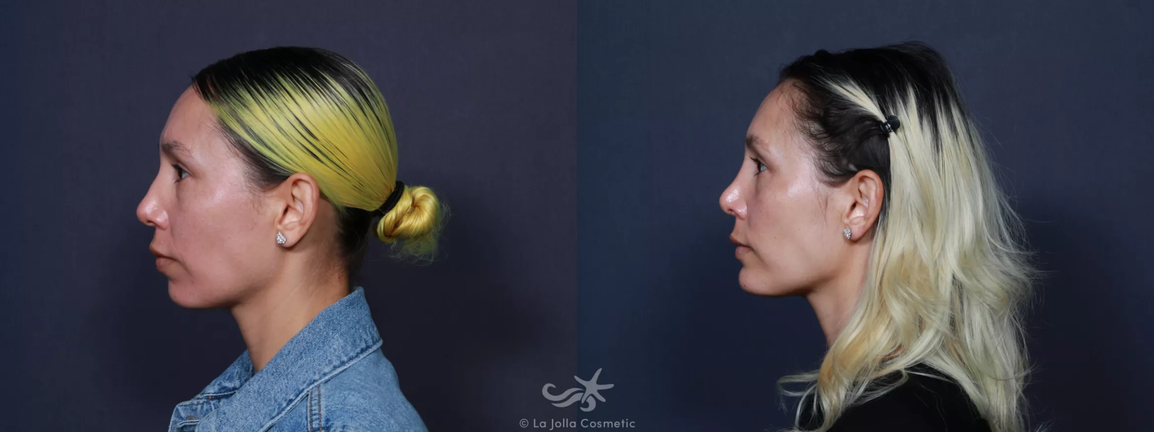 Before & After Rhinoplasty Result 109 Left Side View in San Diego, CA