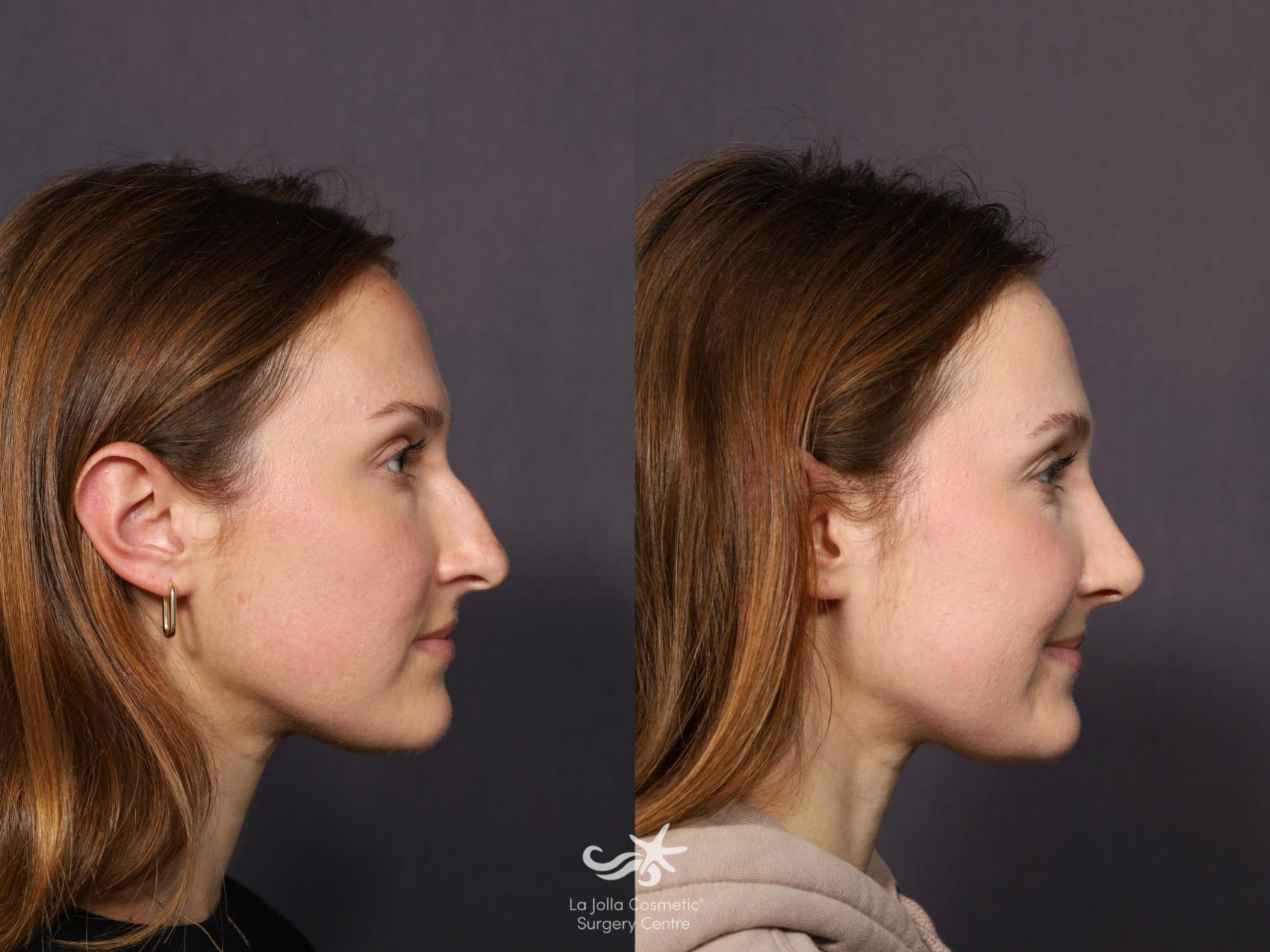 Before & After Rhinoplasty Result 1114 Right Side View in San Diego, CA