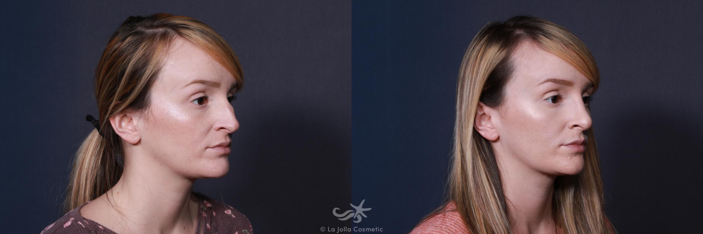Before & After Rhinoplasty Result 220 Right Oblique View in San Diego, CA