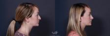 Before & After Rhinoplasty Result 220 Right Side View in San Diego, Carlsbad, CA