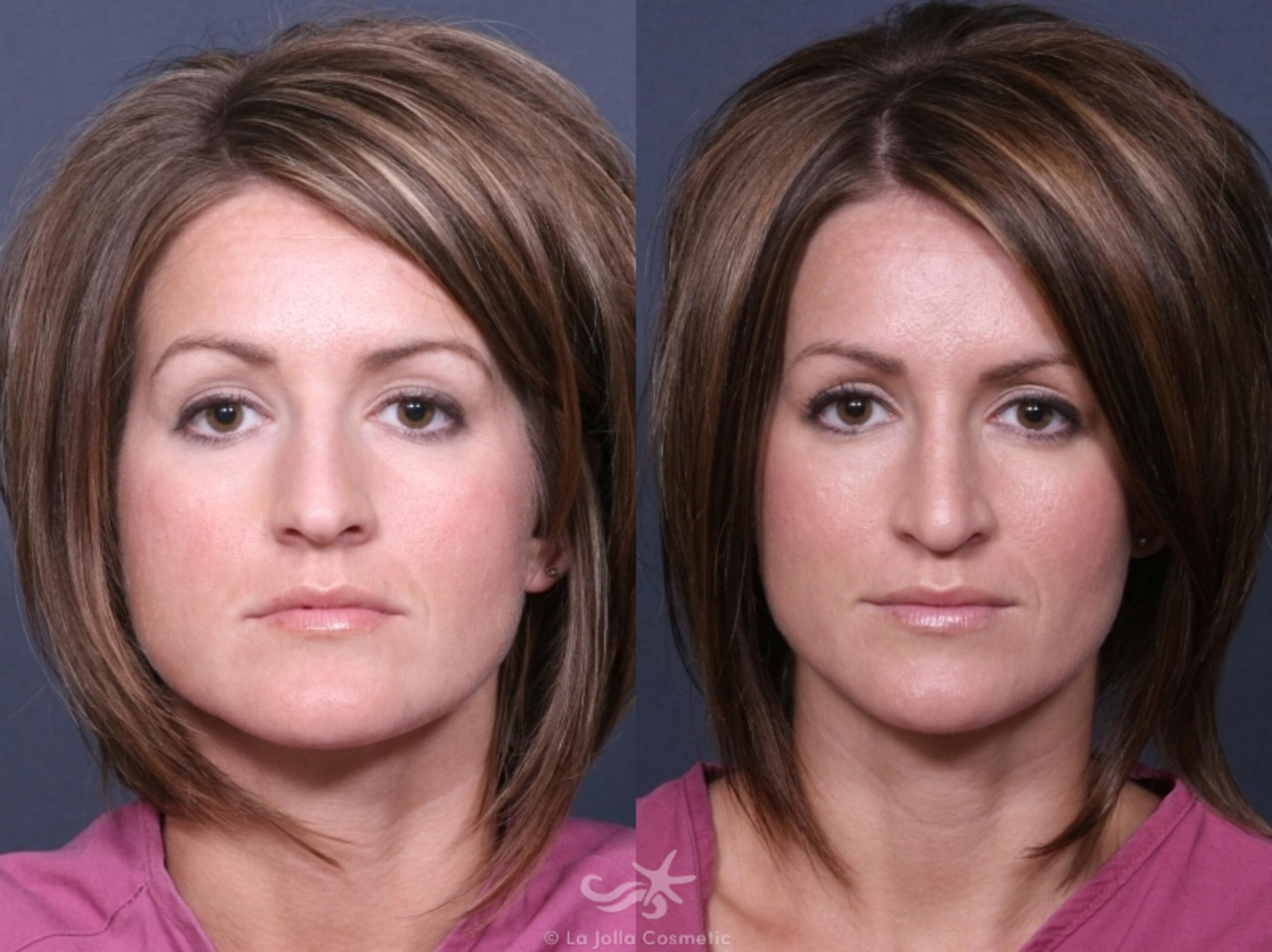 Before & After Rhinoplasty Result 246 Front View in San Diego, CA