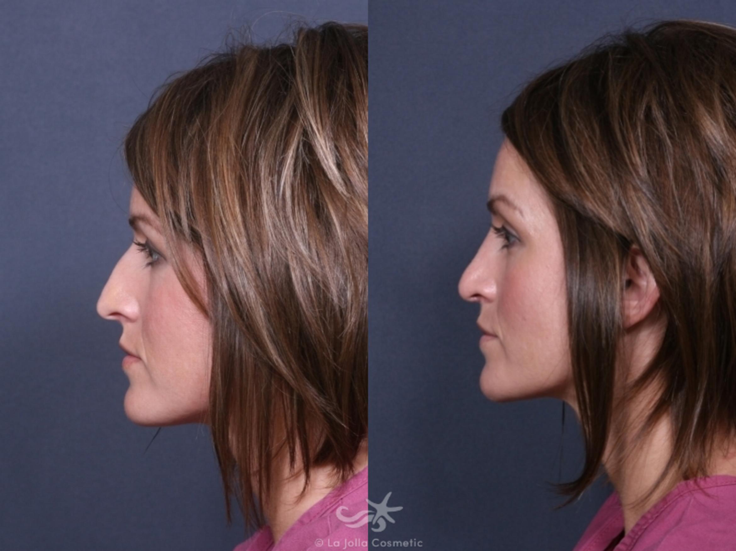 Before & After Rhinoplasty Result 246 Left Side View in San Diego, CA