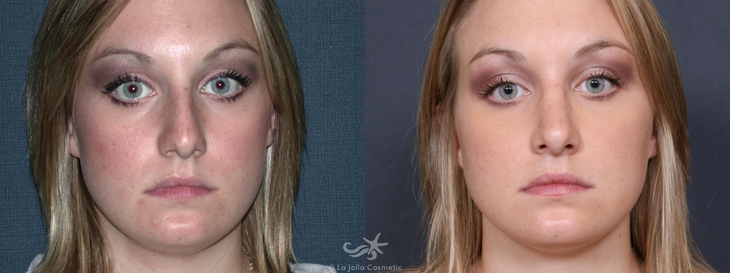 Before & After Rhinoplasty Result 247 Front View in San Diego, CA
