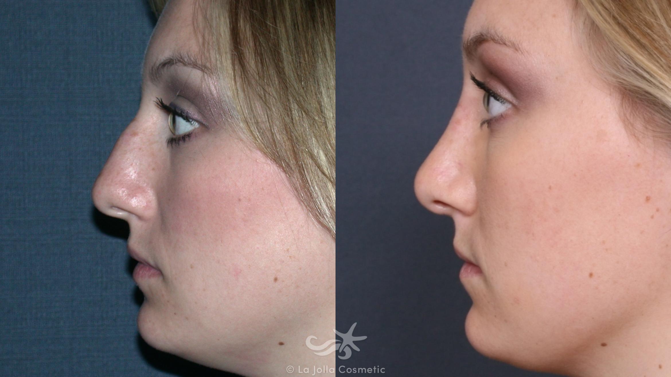 Before & After Rhinoplasty Result 247 Left Side View in San Diego, CA