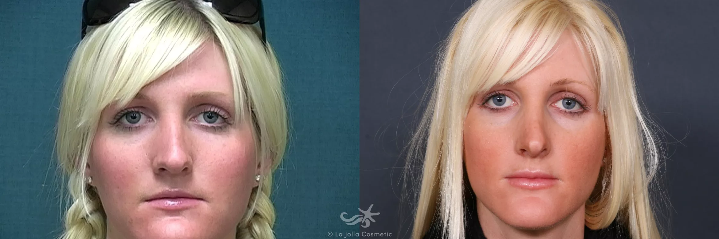 Before & After Rhinoplasty Result 248 Front View in San Diego, CA