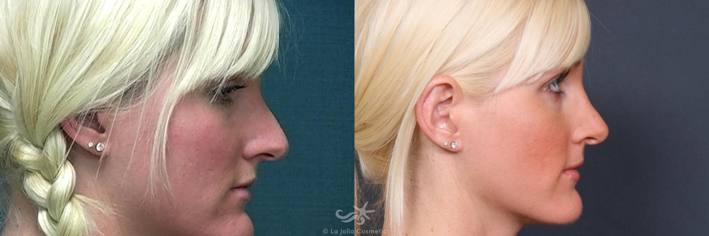 Before & After Rhinoplasty Result 248 Right Side View in San Diego, CA