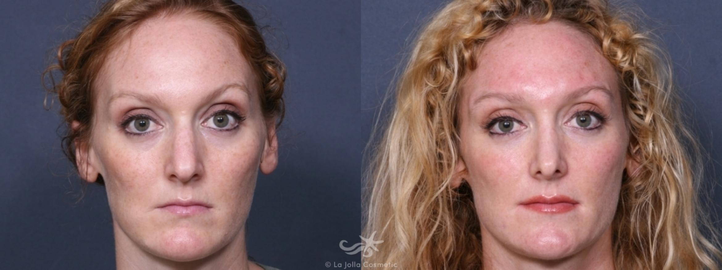 Before & After Rhinoplasty Result 253 Front View in San Diego, CA