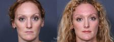 Before & After Rhinoplasty Result 253 Front View in San Diego, Carlsbad, CA