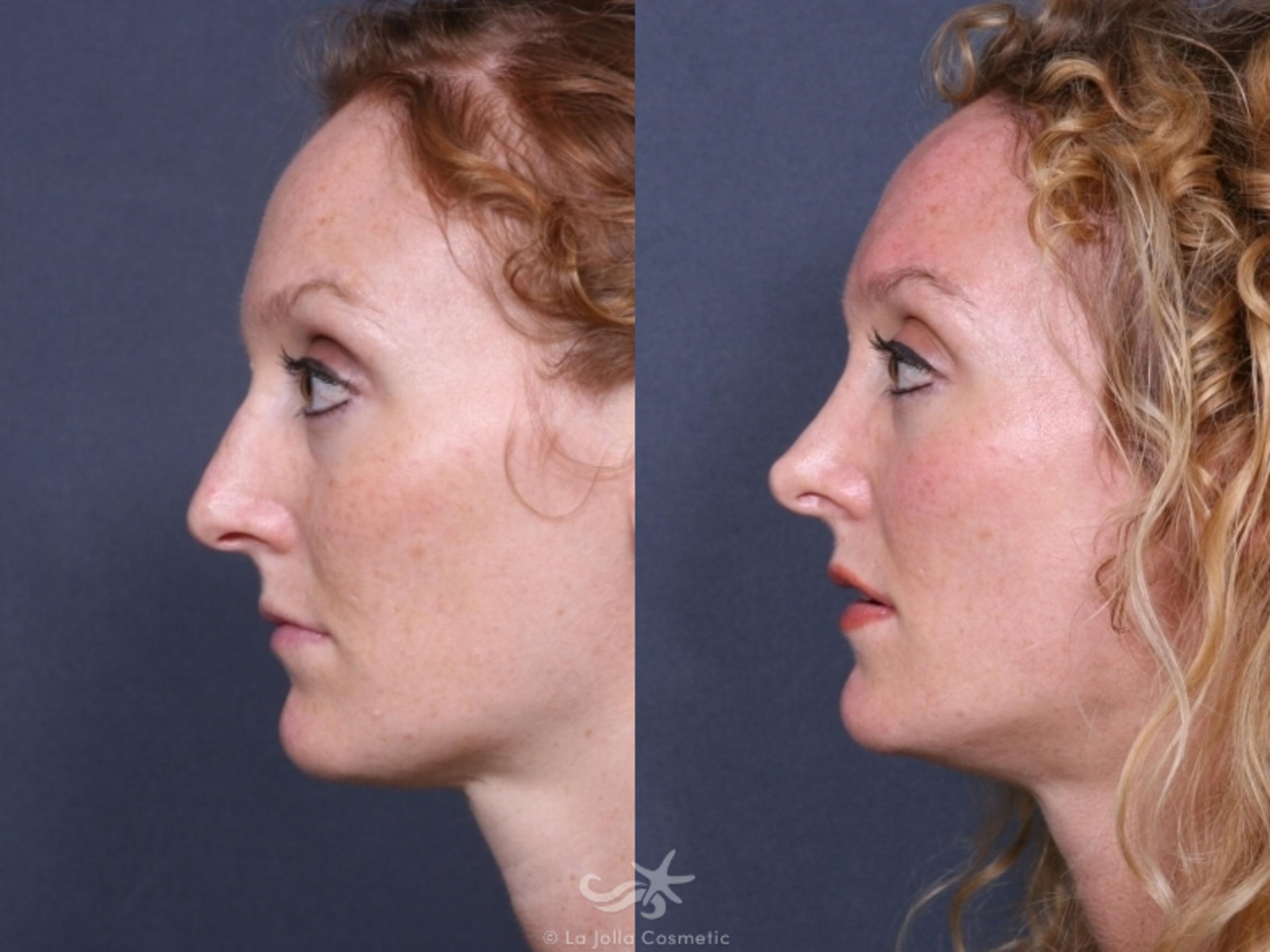 Before & After Rhinoplasty Result 253 Left Side View in San Diego, CA