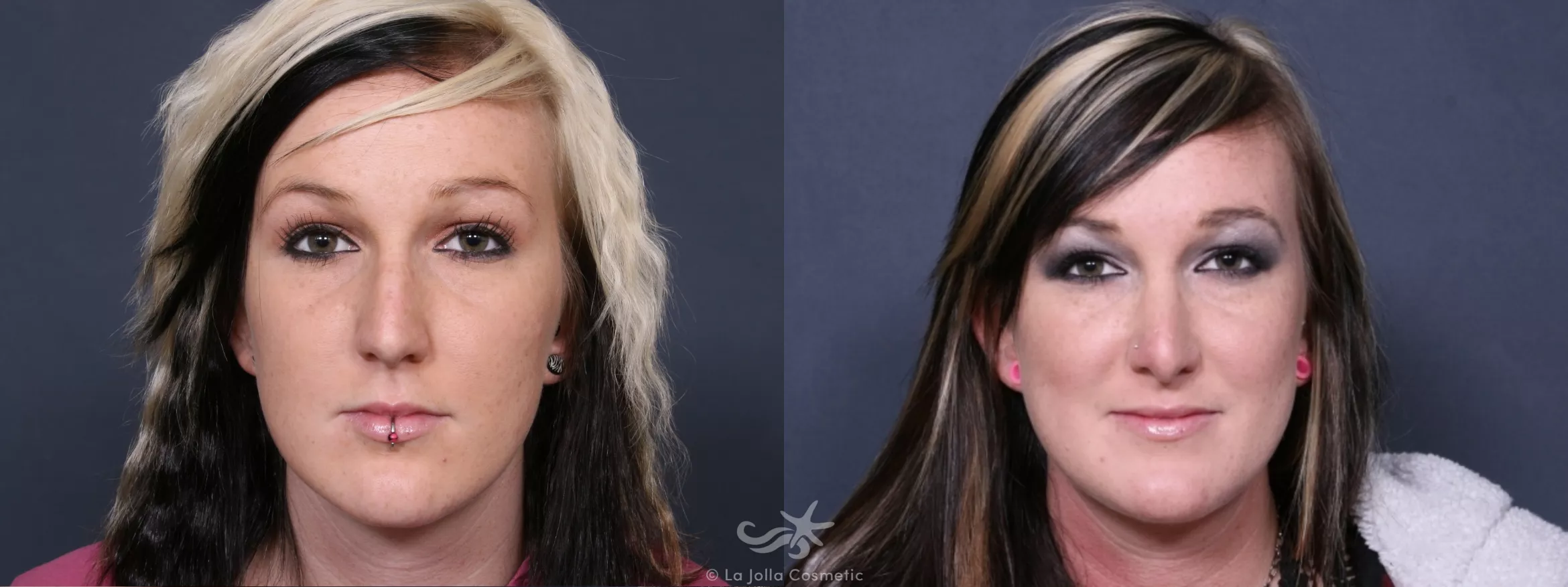 Before & After Rhinoplasty Result 259 Front View in San Diego, CA