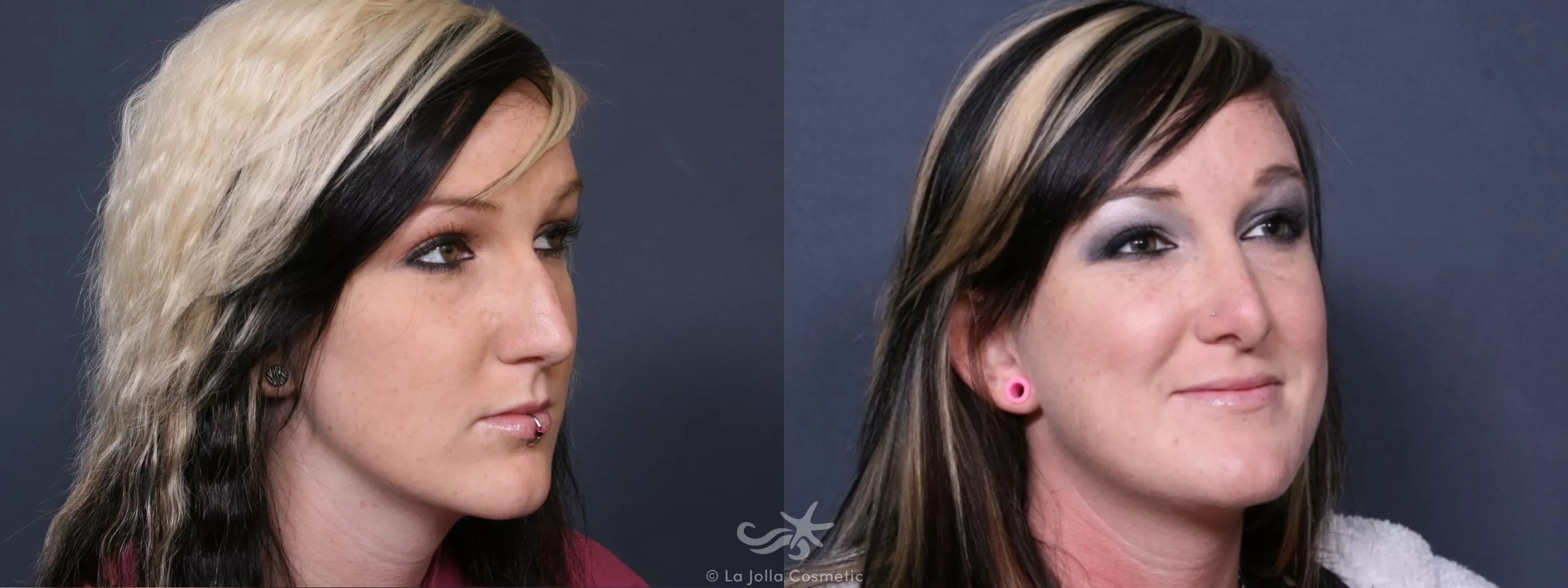 Before & After Rhinoplasty Result 259 Right Oblique View in San Diego, CA
