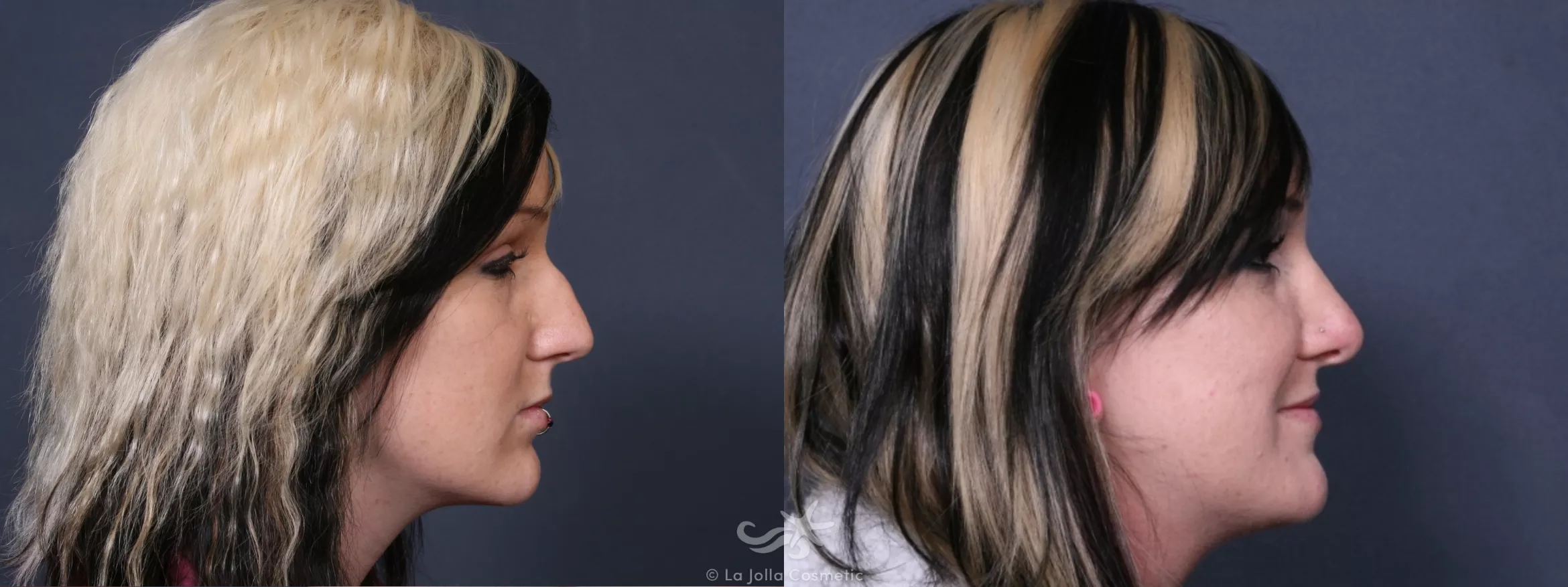 Before & After Rhinoplasty Result 259 Right Side View in San Diego, CA
