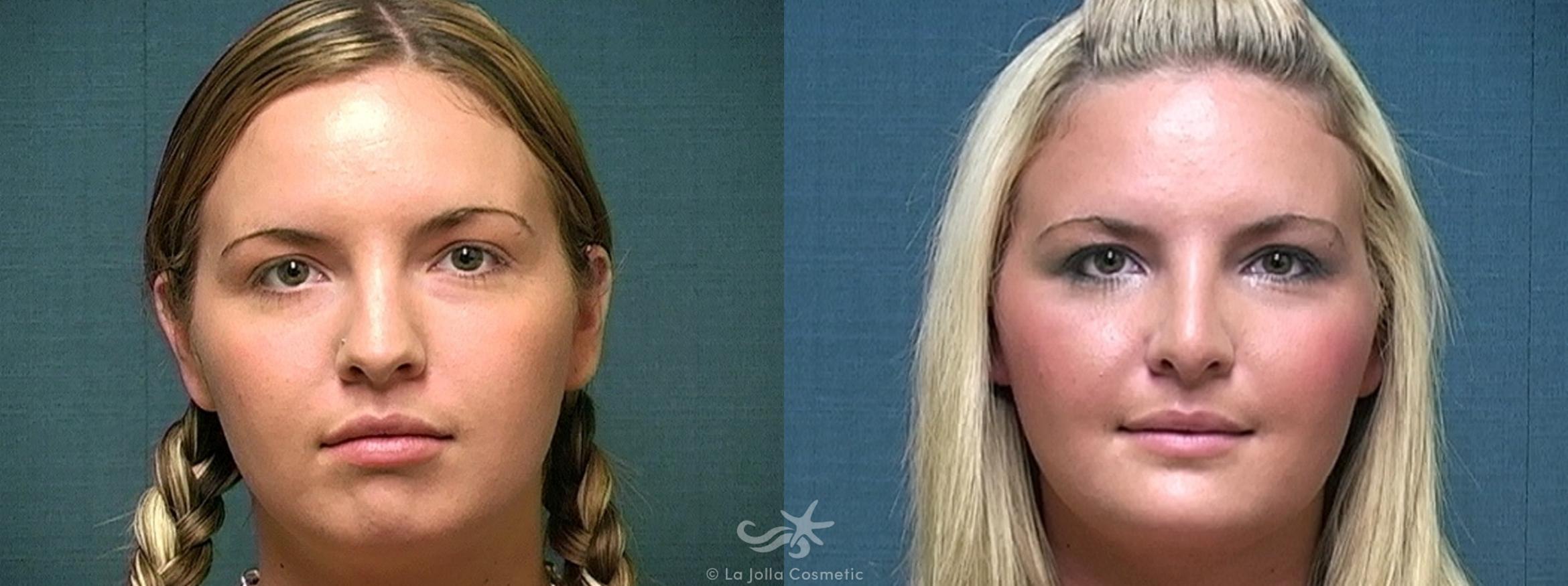 Before & After Chin Enlargement Result 323 Front View in San Diego, CA
