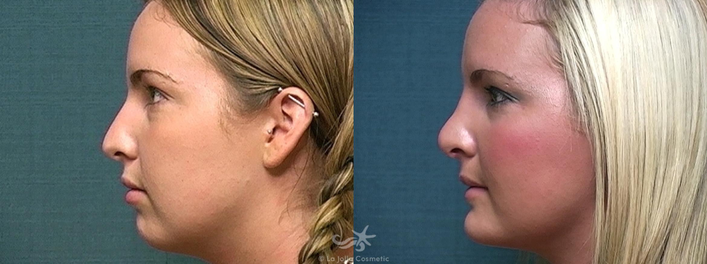 Before & After Rhinoplasty Result 323 Left Side View in San Diego, CA
