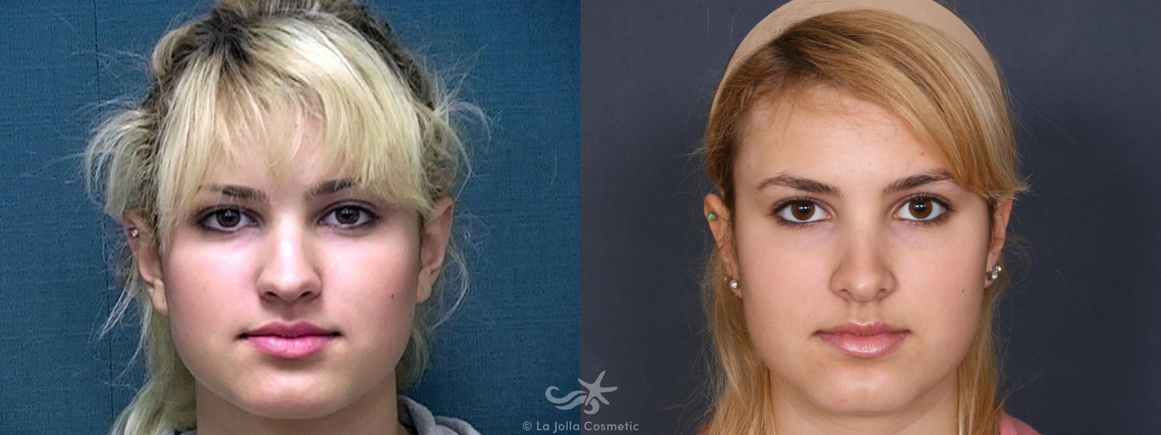 Before & After Rhinoplasty Result 327 Front View in San Diego, CA