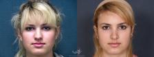 Before & After Rhinoplasty Result 327 Front View in San Diego, Carlsbad, CA