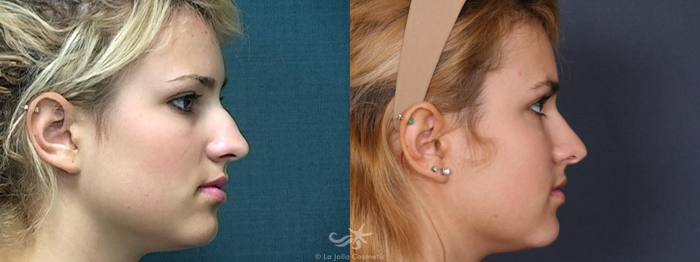 Before & After Rhinoplasty Result 327 Right Side View in San Diego, CA