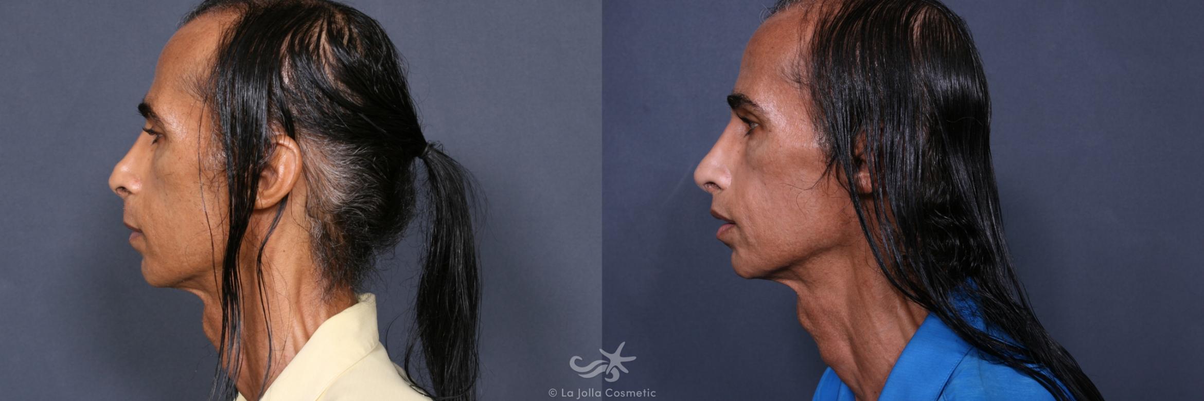 Before & After Rhinoplasty Result 351 Left Side View in San Diego, CA