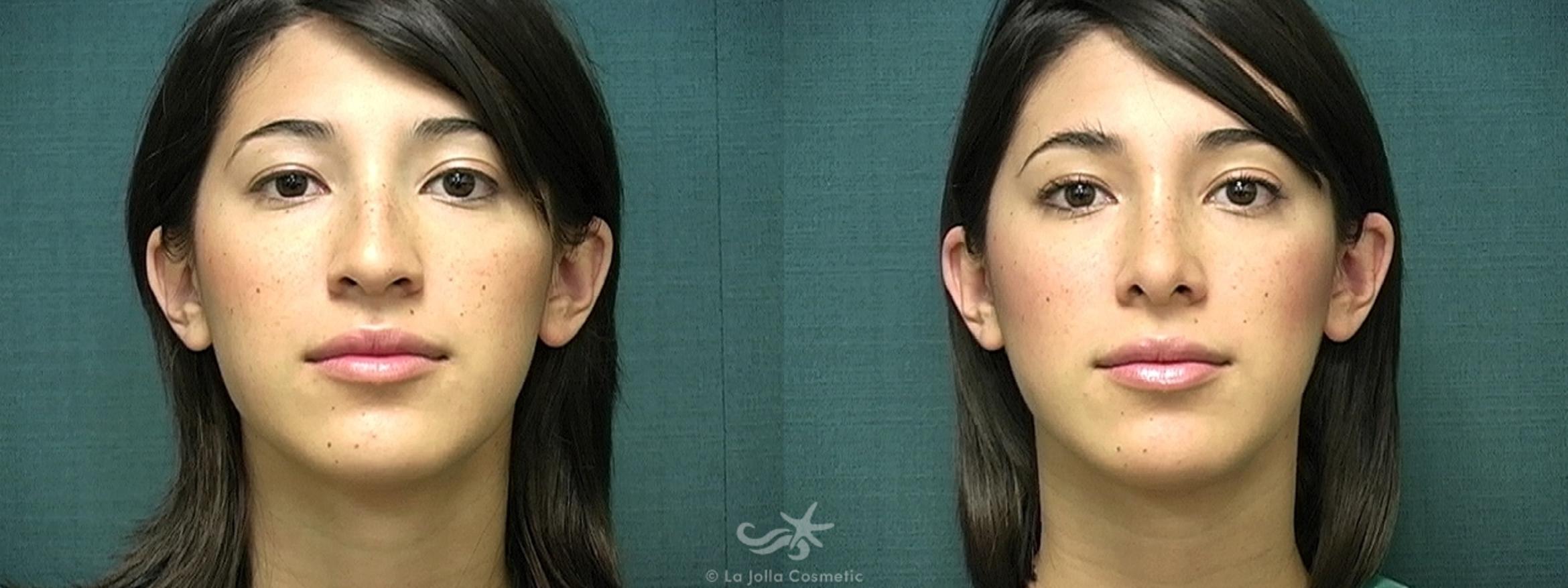 Before & After Rhinoplasty Result 370 Front View in San Diego, CA