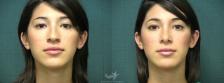 Before & After Rhinoplasty Result 370 Front View in San Diego, Carlsbad, CA