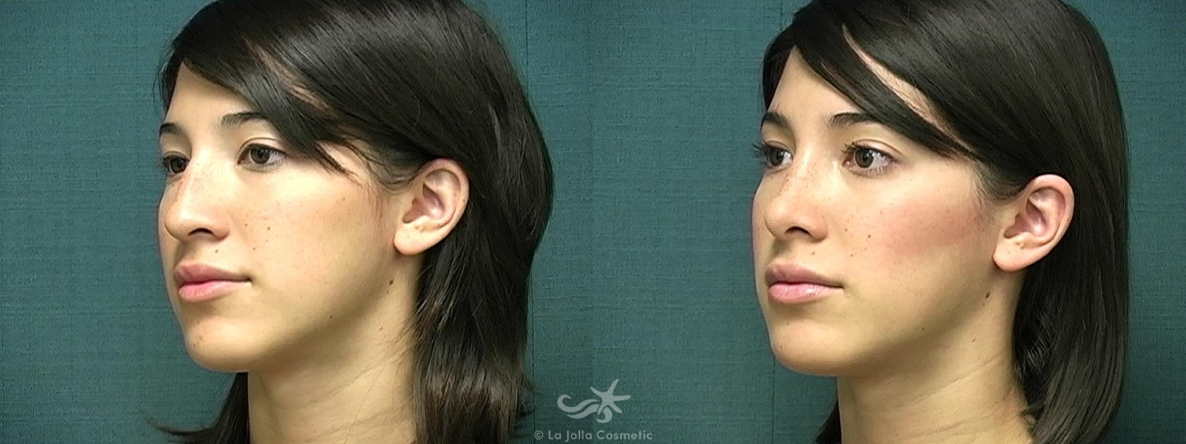 Before & After Rhinoplasty Result 370 Left Oblique View in San Diego, CA