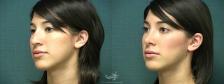 Before & After Rhinoplasty Result 370 Left Oblique View in San Diego, Carlsbad, CA