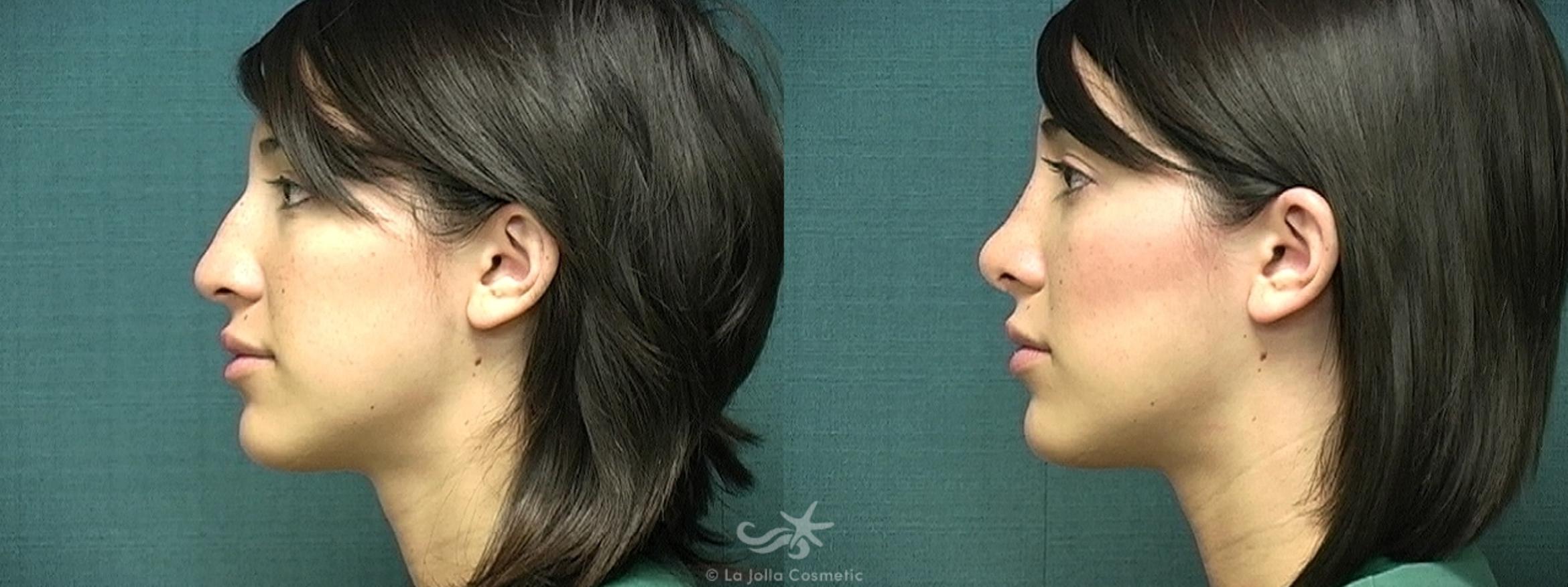Before & After Rhinoplasty Result 370 Left Side View in San Diego, CA