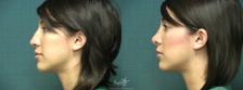 Before & After Rhinoplasty Result 370 Left Side View in San Diego, Carlsbad, CA