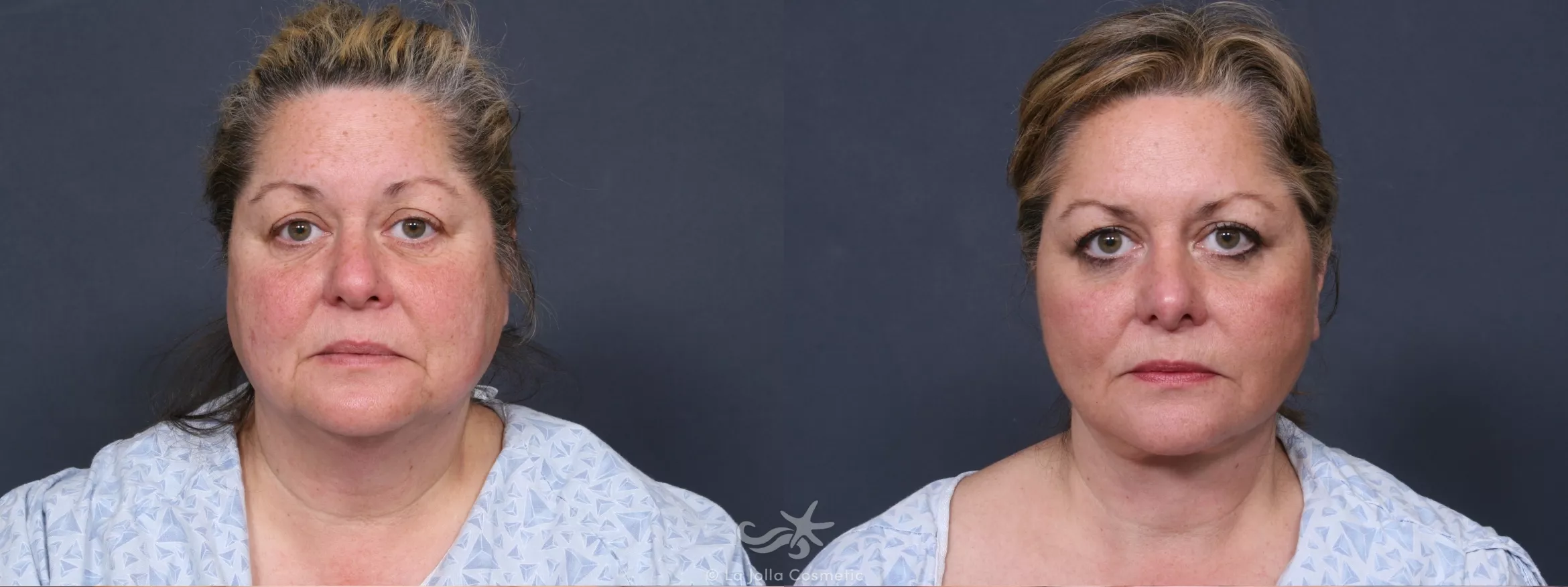 Before & After Rhinoplasty Result 381 Front View in San Diego, CA