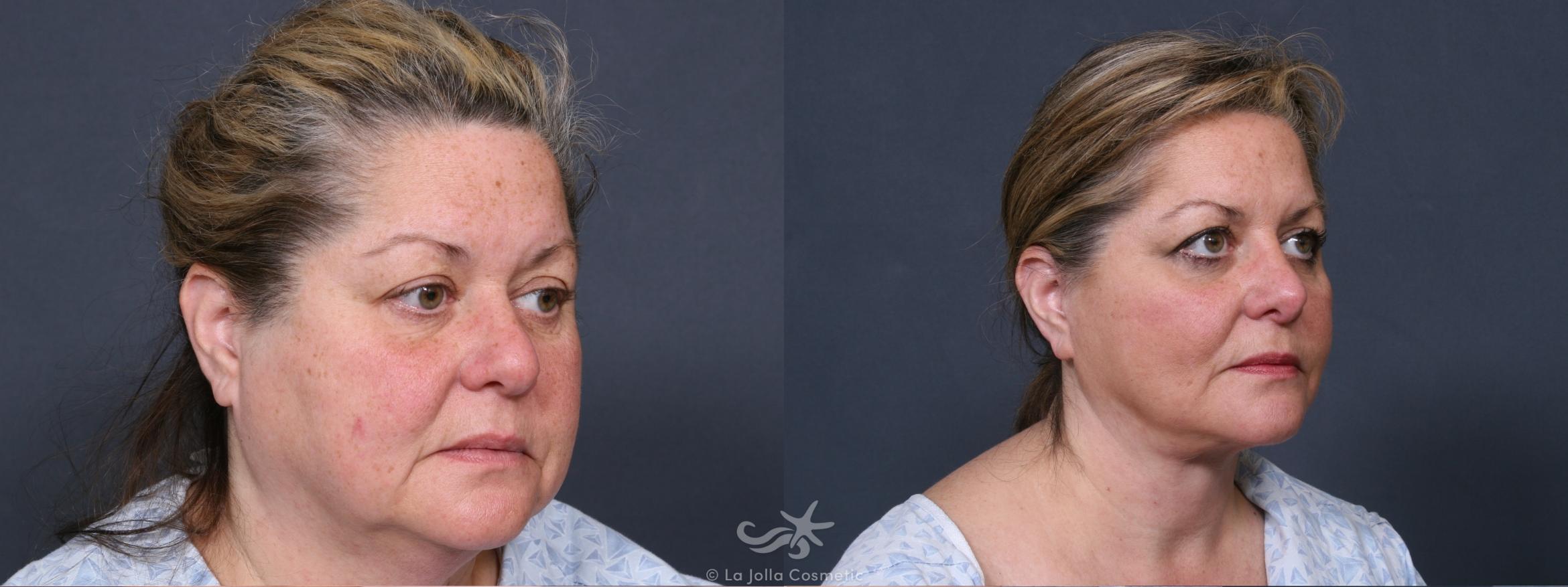 Before & After Rhinoplasty Result 381 Right Oblique View in San Diego, CA