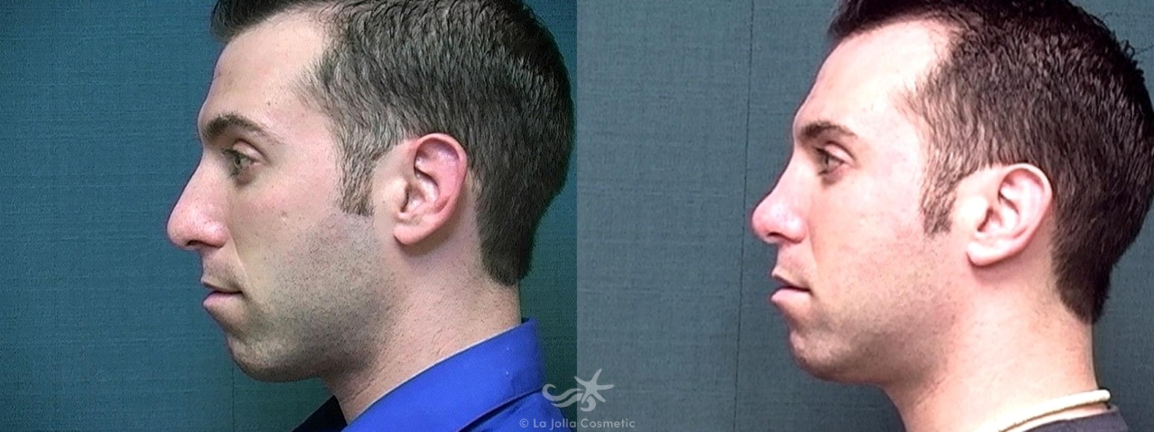 Before & After Rhinoplasty Result 419 Left Side View in San Diego, CA
