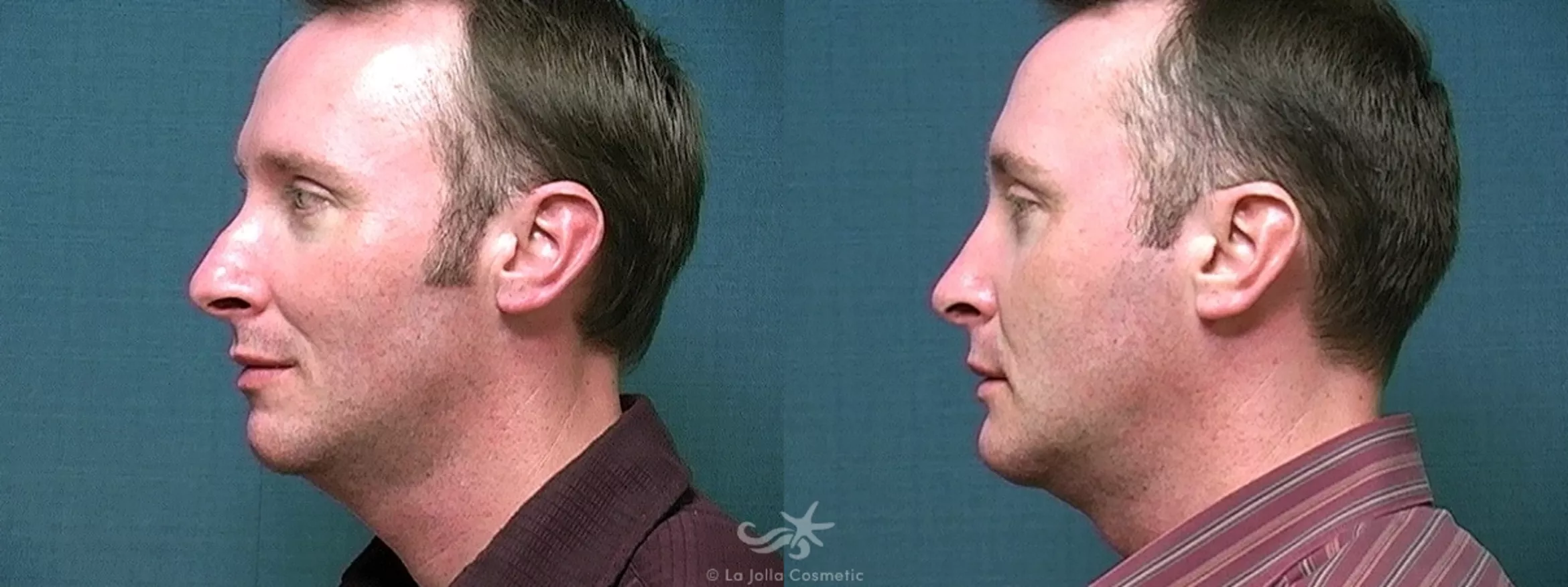 Before & After Rhinoplasty Result 429 Left Side View in San Diego, CA