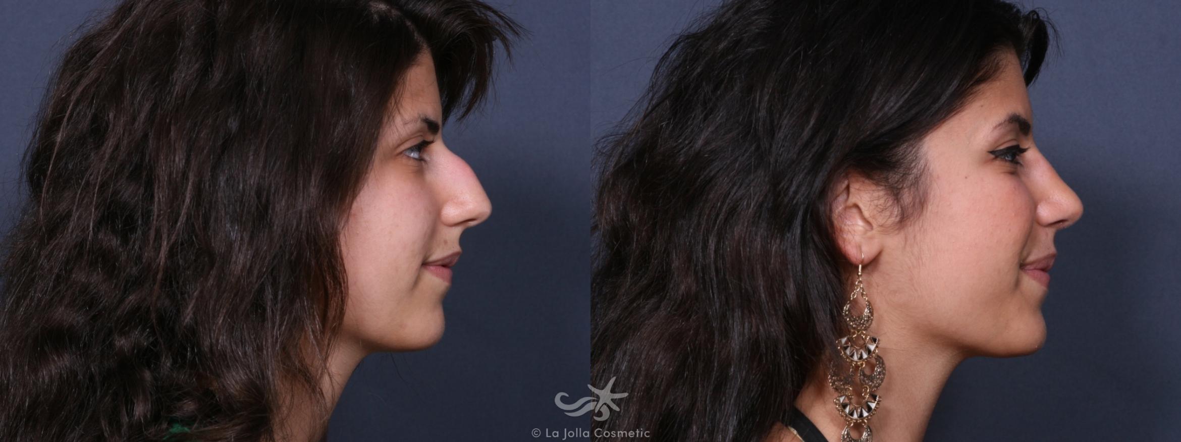 Before & After Rhinoplasty Result 469 Right Side View in San Diego, CA