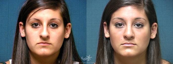 Before & After Rhinoplasty Result 506 Front View in San Diego, Carlsbad, CA