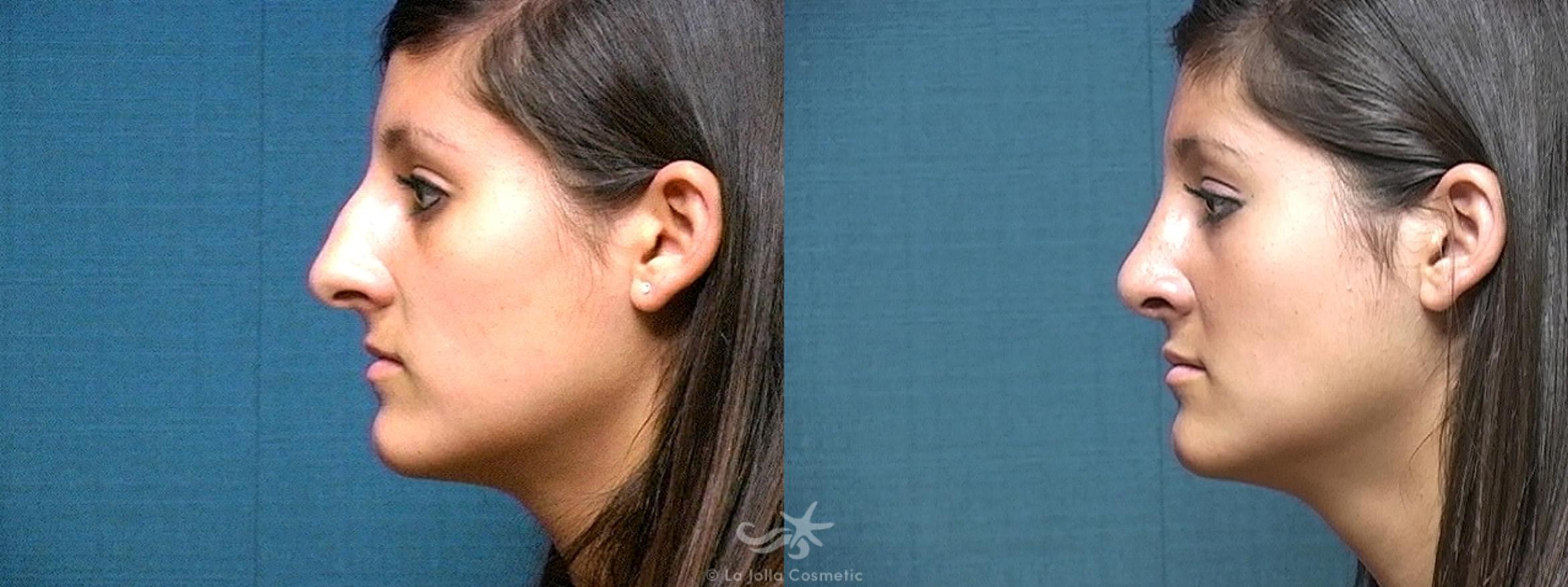 Before & After Rhinoplasty Result 506 Left Side View in San Diego, CA