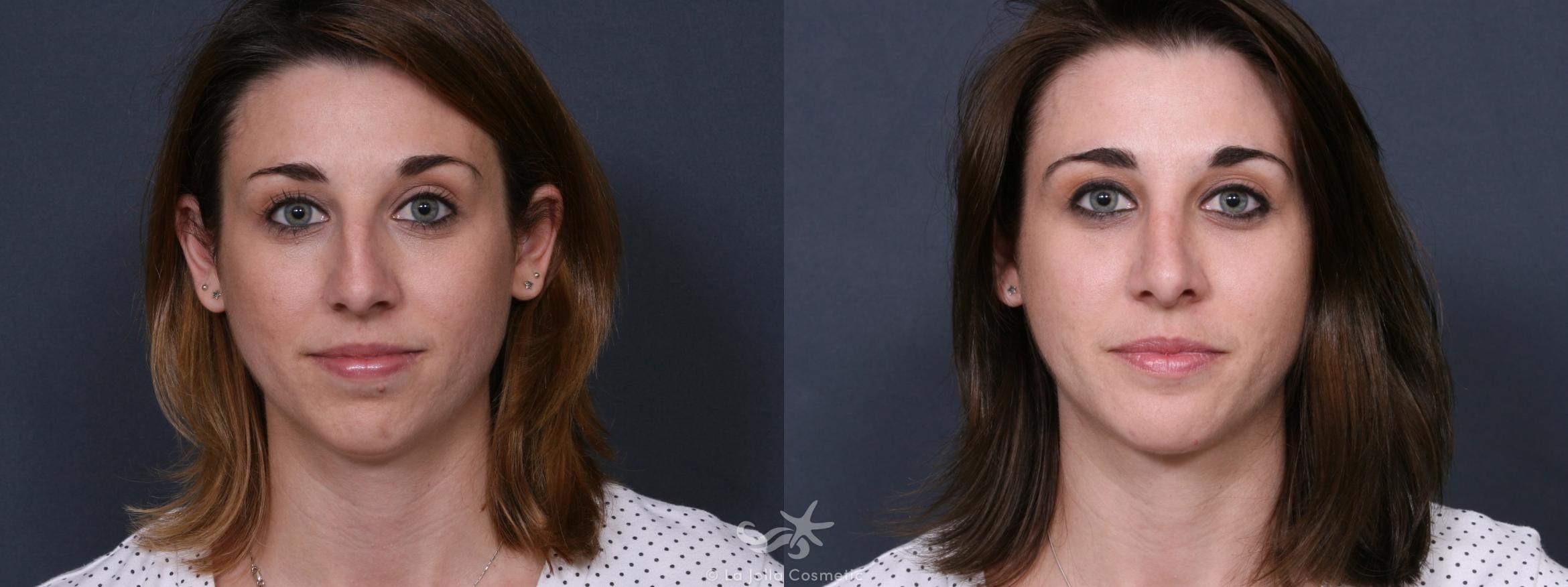 Before & After Rhinoplasty Result 517 Front View in San Diego, CA