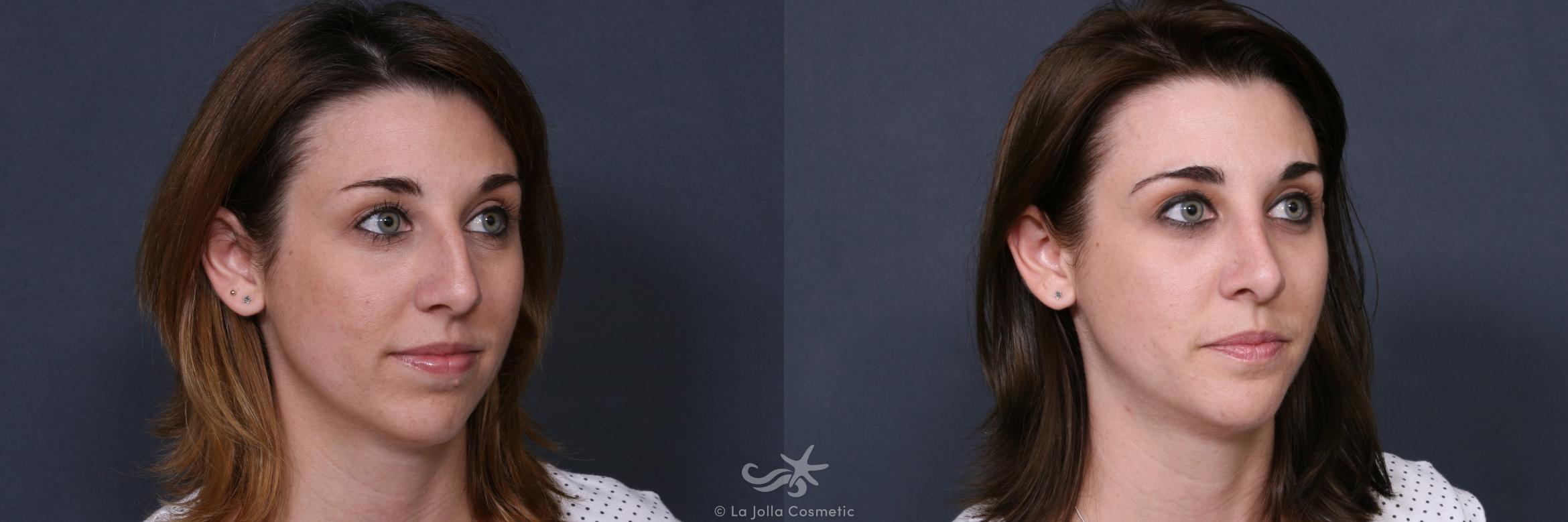 Before & After Rhinoplasty Result 517 Right Oblique View in San Diego, CA