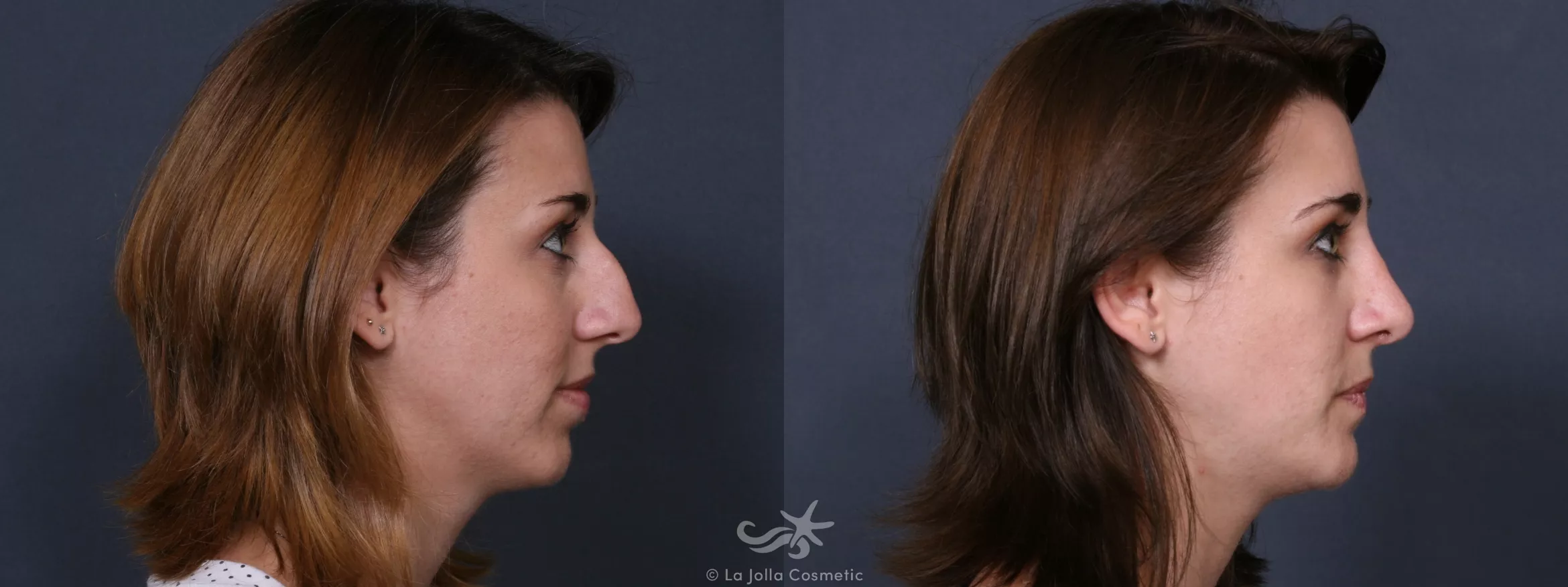 Before & After Rhinoplasty Result 517 Right Side View in San Diego, CA