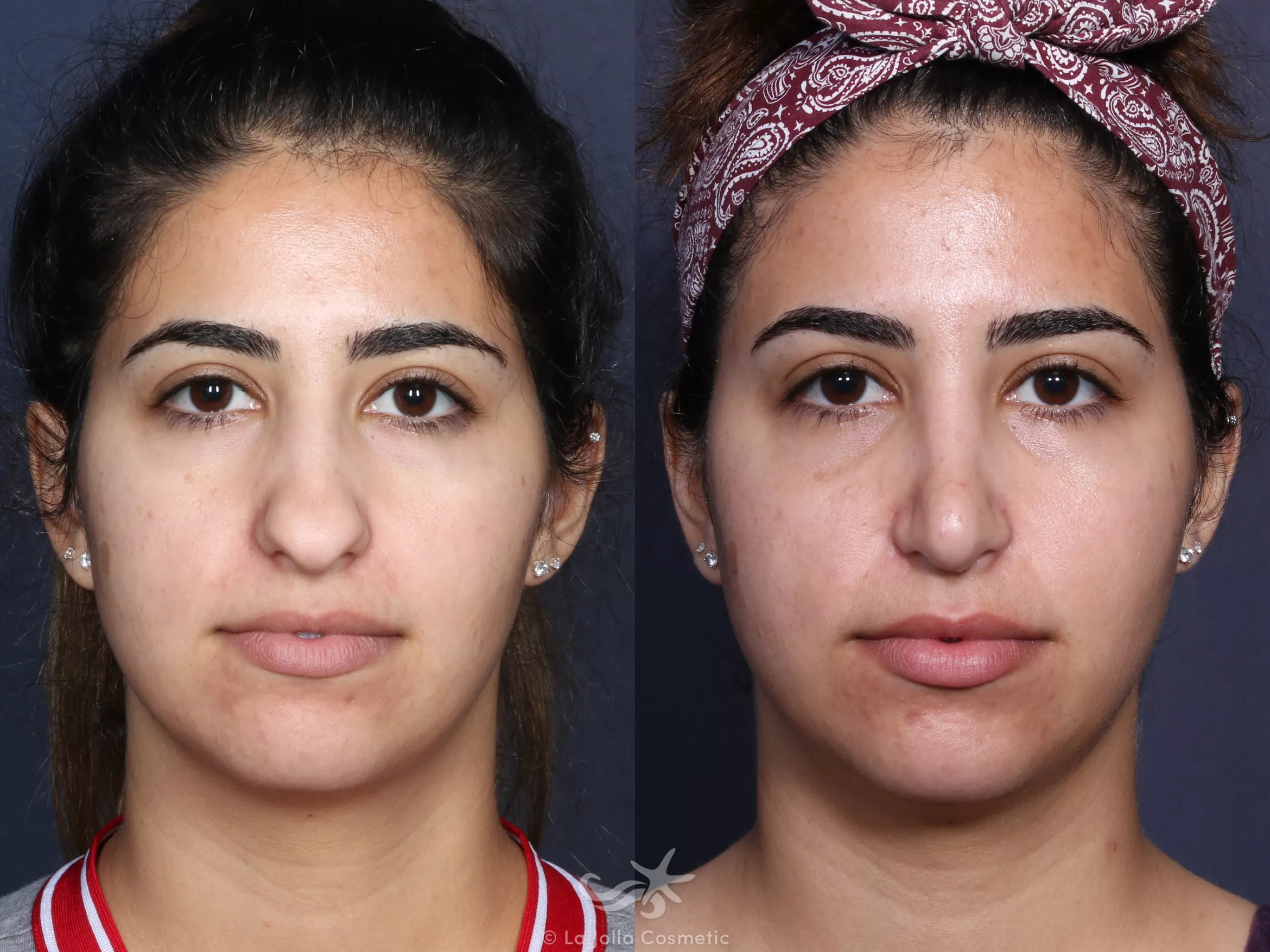 Before & After Rhinoplasty Result 53 Front View in San Diego, CA