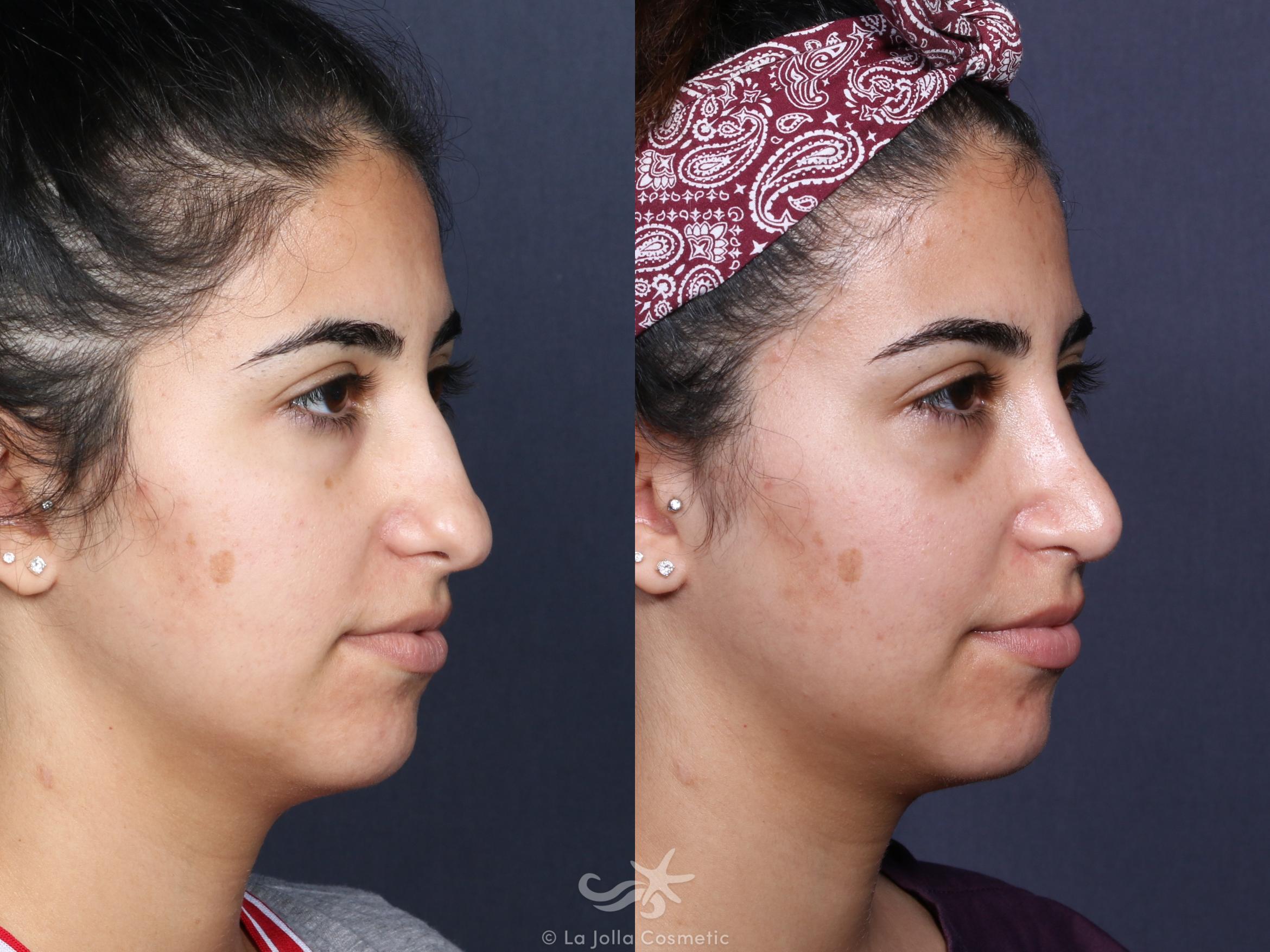 Before & After Rhinoplasty Result 53 Right Oblique View in San Diego, CA