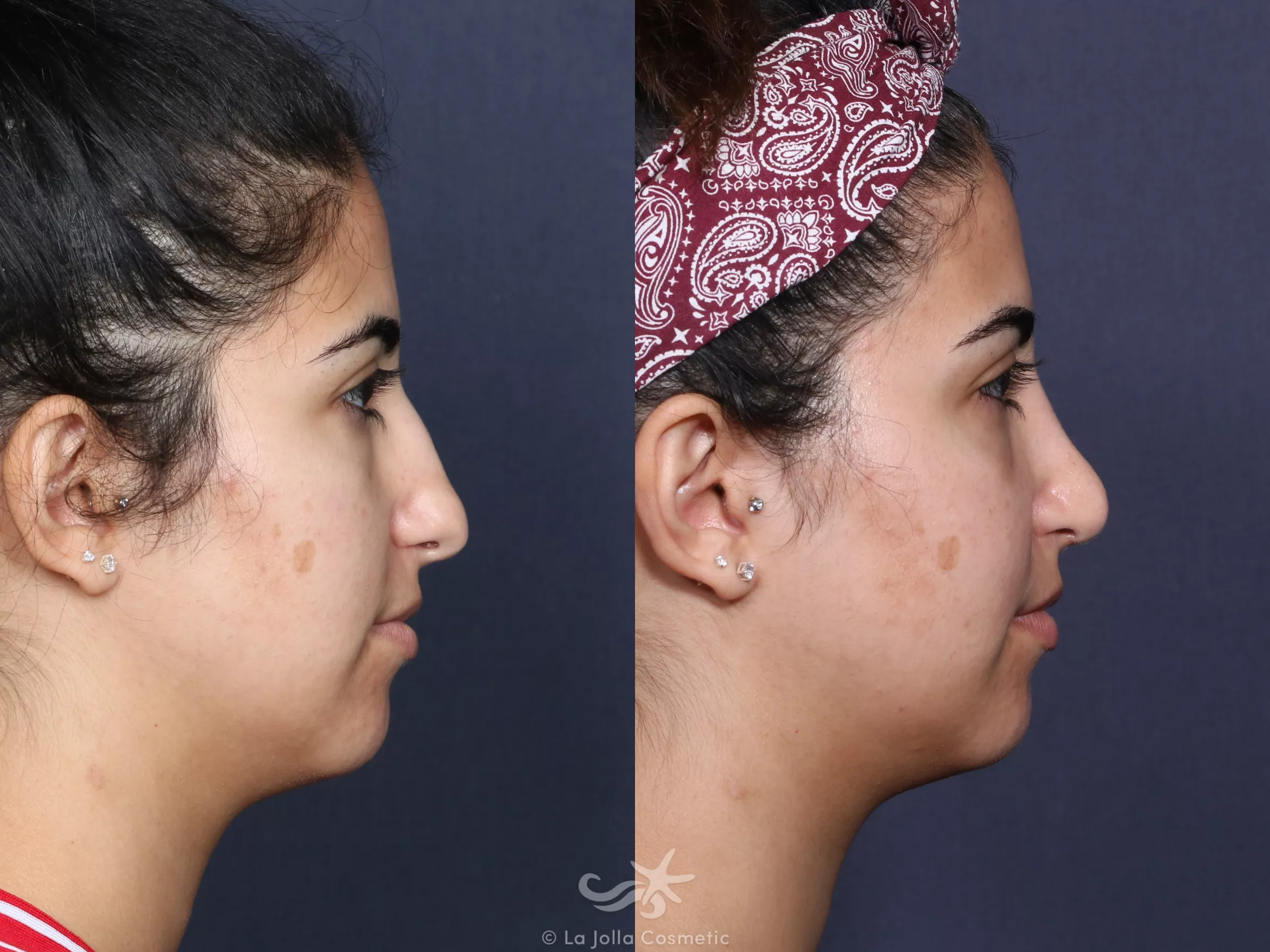 Before & After Rhinoplasty Result 53 Right Side View in San Diego, CA